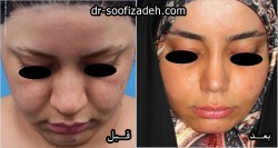 جراحی ابرو