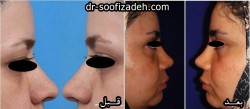 جراحی لیفت ابرو