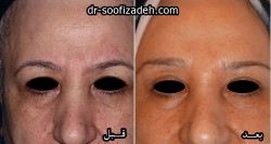 لیفت تاج ابرو
