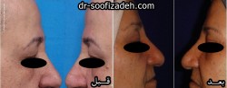 عمل لیفت ابرو