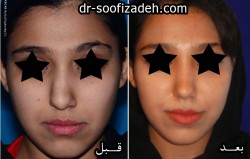 بینی کج