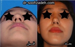 جراحی بینی کج
