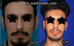 رینوپلاستی