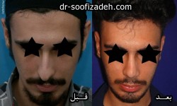 جراحی بینی