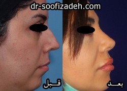 رینوپلاستی