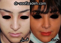 جراحی بینی بسته