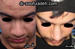 جراحی بینی مردانه صوفی زاده