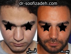 جراحی بینی
