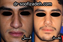عمل بینی رایگان