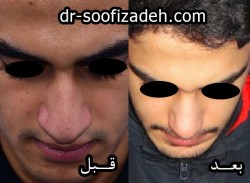 جراحی رایگان بینی