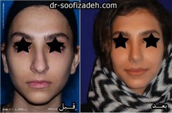 جراحی بینی نیمه فانتزی