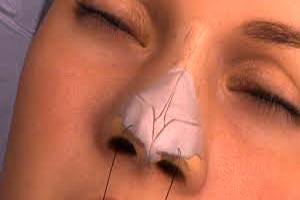 جراحی بینی به سبک طبیعی