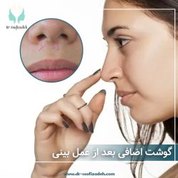 گوشت اضافی بعد از جراحی بینی
