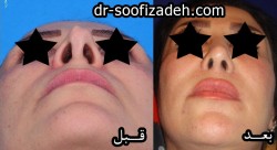 عمل بینی دکتر صوفی زاده