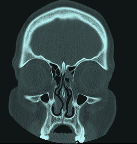 عکس رادیولوژی برای عمل بینی