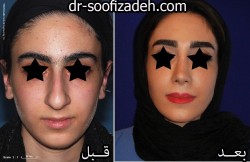 جراحی بینی