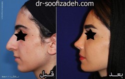 عمل بینی