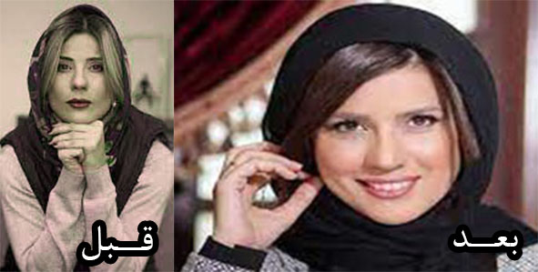 جراحی بینی سارا بهرامی