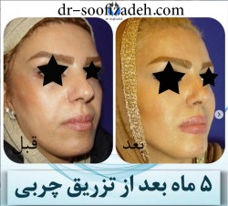 عمل بینی