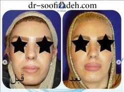 جراحی بینی