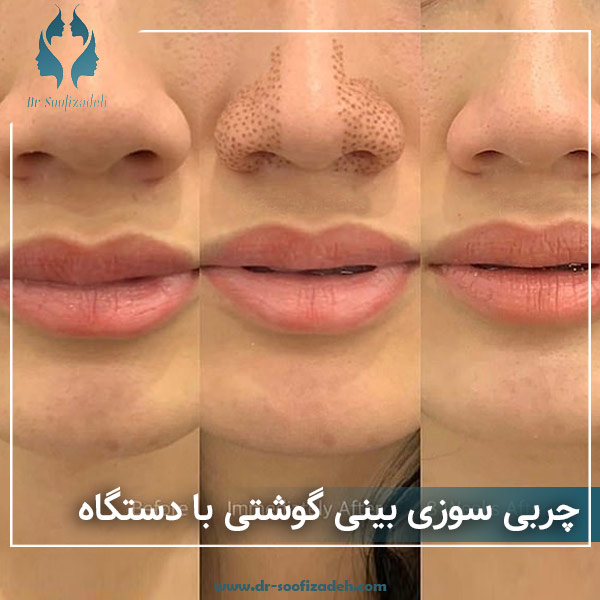 چربی سوزی بینی گوشتی با دستگاه