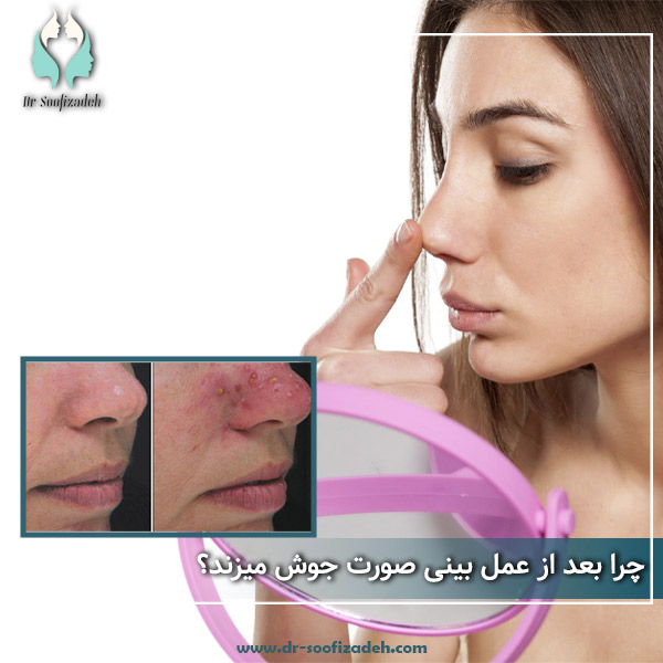 جوش زدن بعد از عمل بینی
