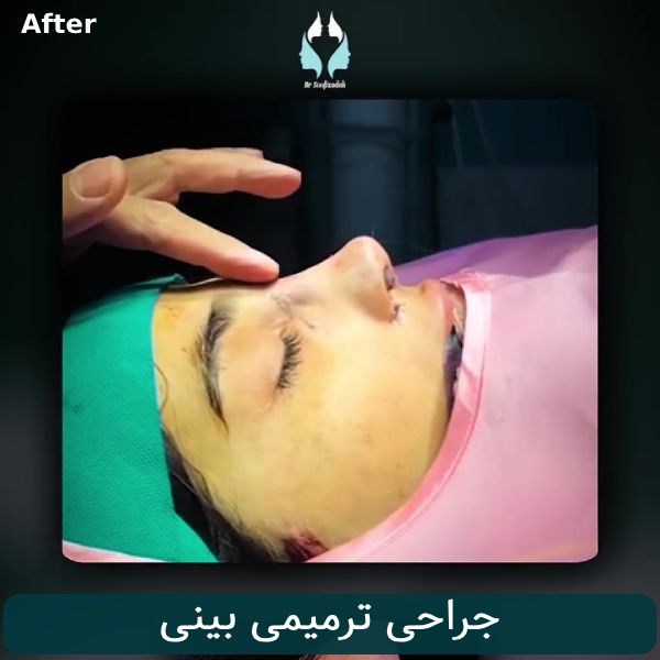 جراحی ترمیمی بینی
