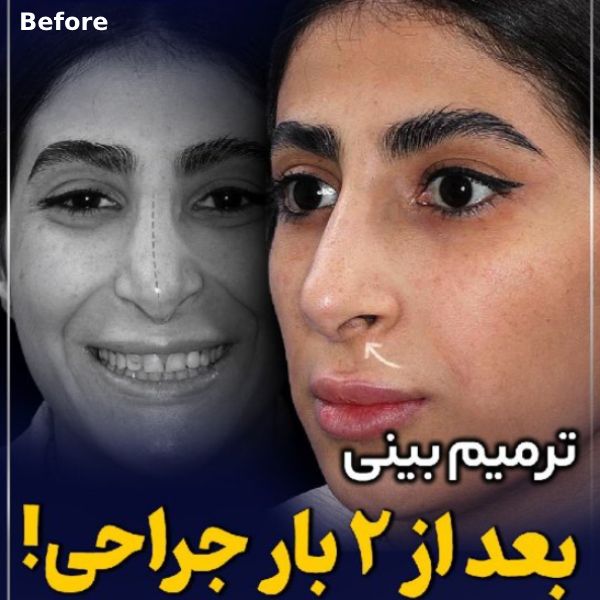 جراحی ترمیمی بینی