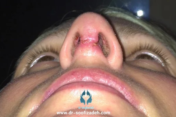 عکس عفونت بینی عمل شده