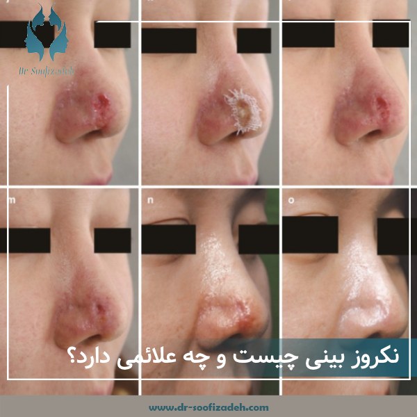 عکس نکروز بینی