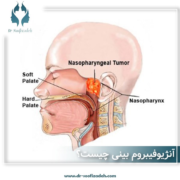 آنژیوفیبروم بینی چیست؟ معرفی شایعترین تومور خوش خیم بینی