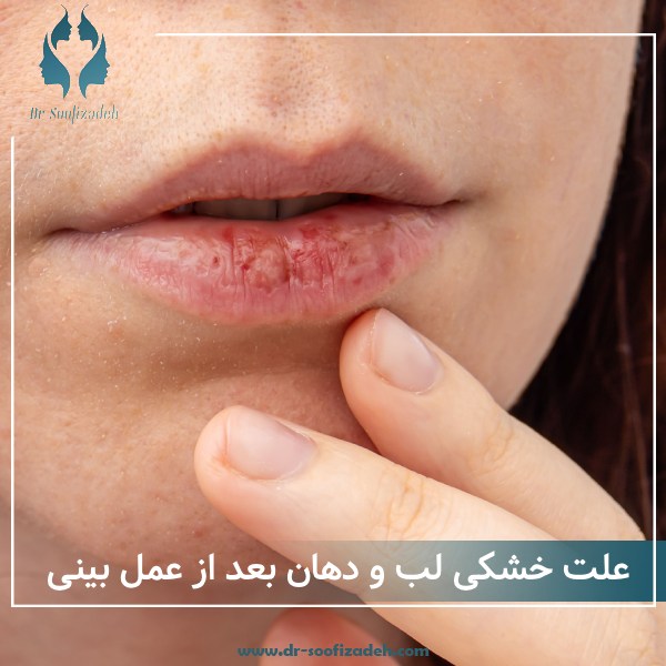 خشکی دهان بعد از عمل بینی